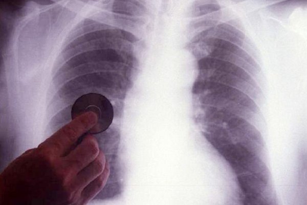 Tuberculosis: Corrientes registra 200 casos por año